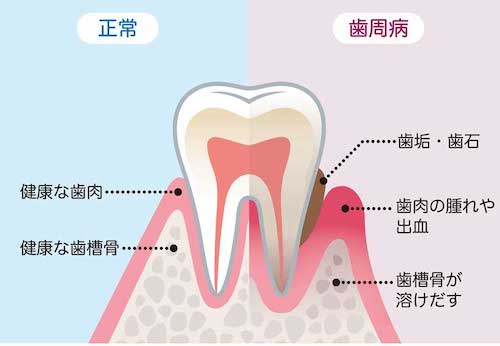 歯周病（歯槽膿漏）とは？