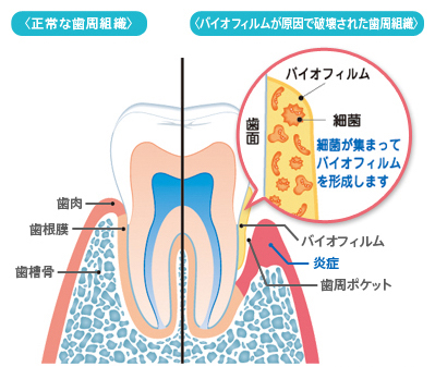 歯周病の主な原因